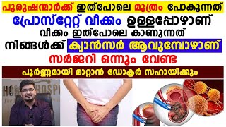 മൂത്രം പിടിച്ചു വെക്കാനാവാതെ പോകുന്നത് പ്രോസ്റ്റേറ്റ് വീക്കം ഉള്ളപ്പോഴാണ്.ഇത് സർജറി ഇല്ലാതെ മാറ്റാം.