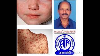 Measles and Homeopathic Treatment അഞ്ചാംപനി അഥവാ മീസിൽസ്