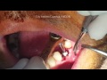 dental implant uygulaması canlı