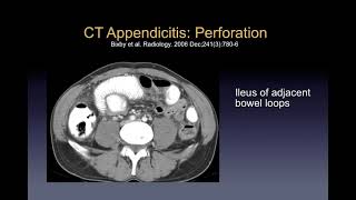 Imaging of appendicitis