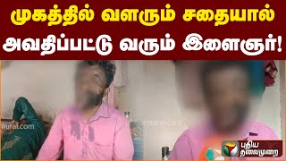 முகத்தில் வளரும் சதையால் அவதிப்பட்டு வரும் இளைஞர்! | PTT