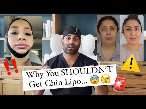 Can you get fat removed from under your chin?