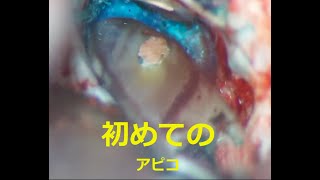 根の先を切る手術(歯根端切除2013年)apicoectomy