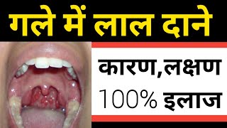 Granular Pharyngitis (गले में लाल दाने) कारण और पक्का इलाज || granular pharyngitis Treatment by dr