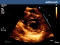 The EchoWeb - Bicuspid Aortic Valve