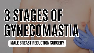 The 3 Stages of Gynecomastia - Male Breast Surgery?!