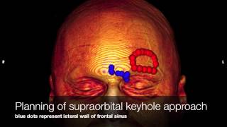 Supraorbital keyhole approach for resection of oligoastrocytoma II