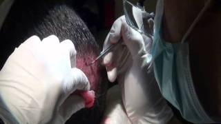 FUE Crown Hair Transplant by Dr. Dorin