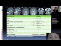 acns webinar apr 27 endoscopic pituitary surgery u0026 ais thrombectomy