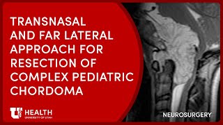 Transnasal and Bilateral Far Lateral Approach for Complex Pediatric Chordoma