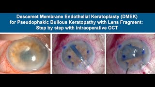 DMEK for Pseudophakic Bullous Keratopathy with Anterior Chamber Retained Lens Fragments