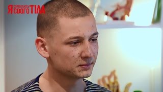 Виталий Кравченко хочет убрать последствия производственной травмы-Я соромлюсь свого тіла-26.03.15