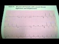 EKG Uri M. Ben-Zur, M.D., F.A.C.C. - Cardiovascular Electrocardiogram