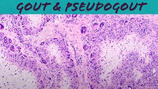 Gout \u0026 Pseudogout (calcium pyrophosphate deposition disease - chondrocalcinosis) pathology USMLE