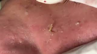 Deep Blackheads Removal from Cheeks and Nose  Best Pimple Popping Videos