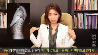 Real Case 11. 일자목으로 척추와 허리까지 굽어진  치료 사례