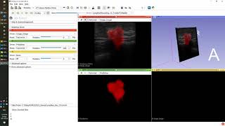 Real-time ultrasound AI segmentation and volume reconstruction