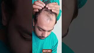 Amazing Hair Transplant Results with FUE Technique | 5000 #Follicles 8 Months Result