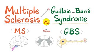 Multiple Sclerosis (MS) vs. Guillain-Barré Syndrome (GBS)- Causes, Symptoms, Diagnosis & Treatment