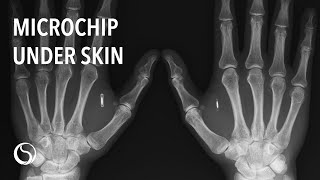 Biohax Microchip Implant | Merging with Technology