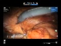 Robotic Thymectomy