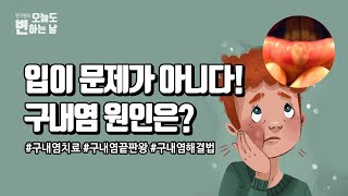 입안이 허는 구내염 치료법! 원인 치료로 재발없이 완벽하게!