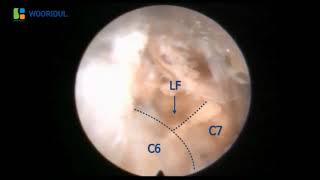 Posterior Endoscopic Cervical Foraminotom/C6 7,Left/PECF