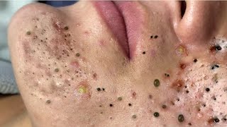 Big Cystic Acne Blackheads Extraction Blackheads \u0026 Milia, Whiteheads Removal Pimple Popping # 1631