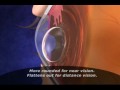 How Cataracts Are Formed Khanna Vision Institute