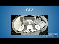 cvi 2019_thursday 7 18_ acute and chronic venous disease_brooke spencer md