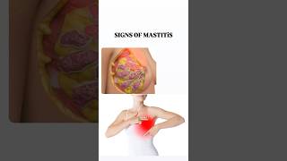 Mastitis Awareness: Recognizing the Warning Signs #mastitis #mastitissymptoms#shortsviral