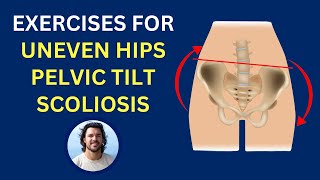 BEST Exercises for Uneven Hips, Scoliosis, Pelvic Imbalance