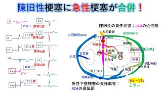 心電図：暗記からの卒業 66話 陳旧性心筋梗塞