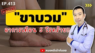 ขาบวม อาการเตือน 5 โรคร้าย ที่คุณควรรู้ | เม้าท์กับหมอหมี EP.413