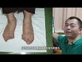 拇外翻会不会其余器官造成影响和损伤？hallux valgus