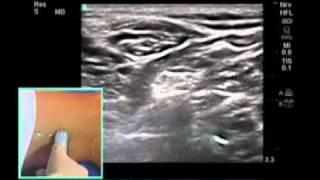 How To: Ultrasound-Guided Popliteal Sciatic Nerve Block Scanning Technique Video