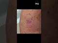 What Does Common Skin Cancer Look Like On...  Volume 2