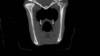 Dentigerous cyst (axial)