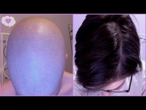 Hair Regrowth After Chemo Hair Regrowth After Chemo