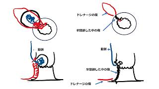 内痔核の手術後、傷の治りを悪くする要因