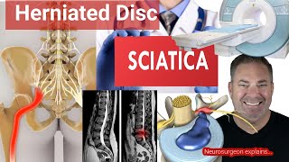 3 Things to Know About SCIATICA or BACK PAIN due to a HERNIATED DISC | Neurosurgeon explains