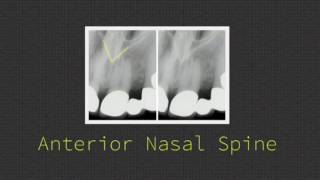 Anatomy on Intraoral Radiographs