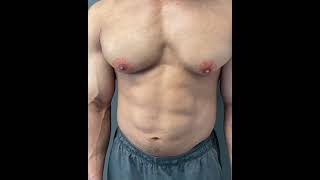 Pure Gynecomastia in a 29 yo body builder