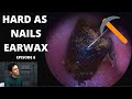 Hard As Nails Ear Wax EPISODE 6