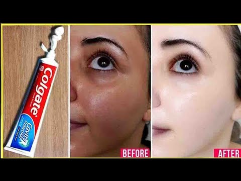 Apply Toothpaste on Your Skin and See Magical Result within 1 Hour │Amazing Toothpaste Beauty Hacks Apply Toothpaste on Your Skin and See Magical Result within 1 Hour │Amazing Toothpaste Beauty Hacks
