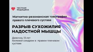 МРТ правого плечевого сустава «Разрыв сухожилия надостной мышцы» от компании Честная Медицина