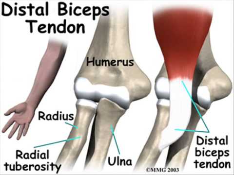 Tendinitis Distal Del Biceps_0002 - YouTube