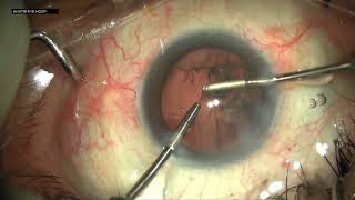 Routine Phacoemulsification surgery