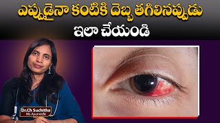 Do this whenever you get an eye injury |ఎప్పుడైనా కంటికి దెబ్బ తగిలినప్పుడు ఇలా చేయండి | Dr.Suchitha