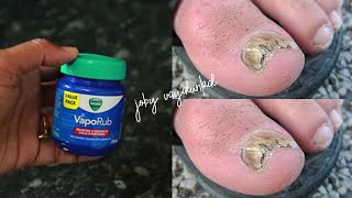 കുഴി നഖം ഇനി ഒരു പ്രശ്നമല്ല 😍 വിക്സ് (VICKS VAPORUB) ഉണ്ടോ ?? How to Cure Toenail Fungus At Home |